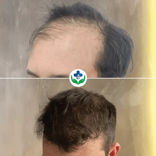hair transplant colombia