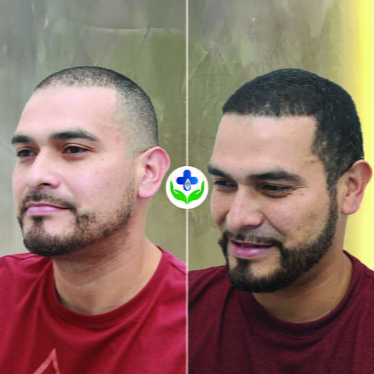 beard transplant colombia