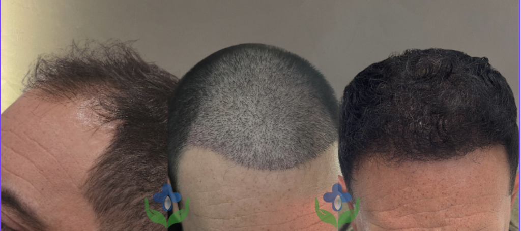 before and after hair transplant colombia care