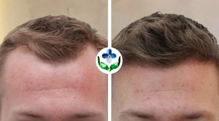 Before and after hair transplant photos showing hair restoration progress.