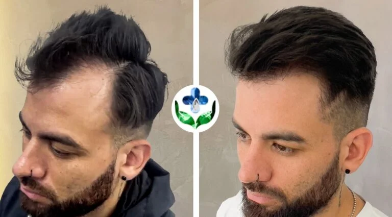 hair transplant colombia care results