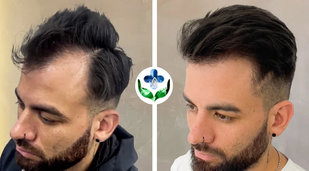hair transplant colombia care results