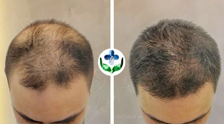Male hair transplant before and after photos showing hair growth improvement.