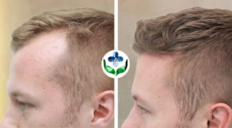 Before and after hair transplant on a man's scalp, showing improved hair density.