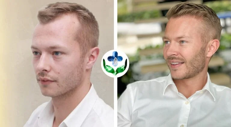 Before and after hair transplant on a young man, April 2023.