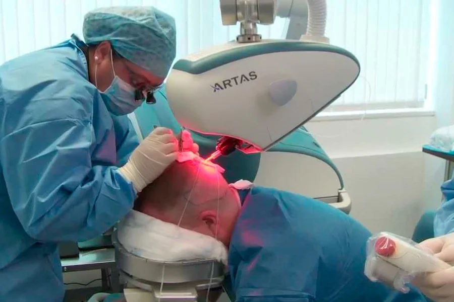The ARTAS® robotic system is useful because each person has a unique hair pattern and this the technology eliminates the possibility of human error so that the rate of follicular damage during extraction is minimal (FUS 25 to 30%; manual FUE 25-30%...
