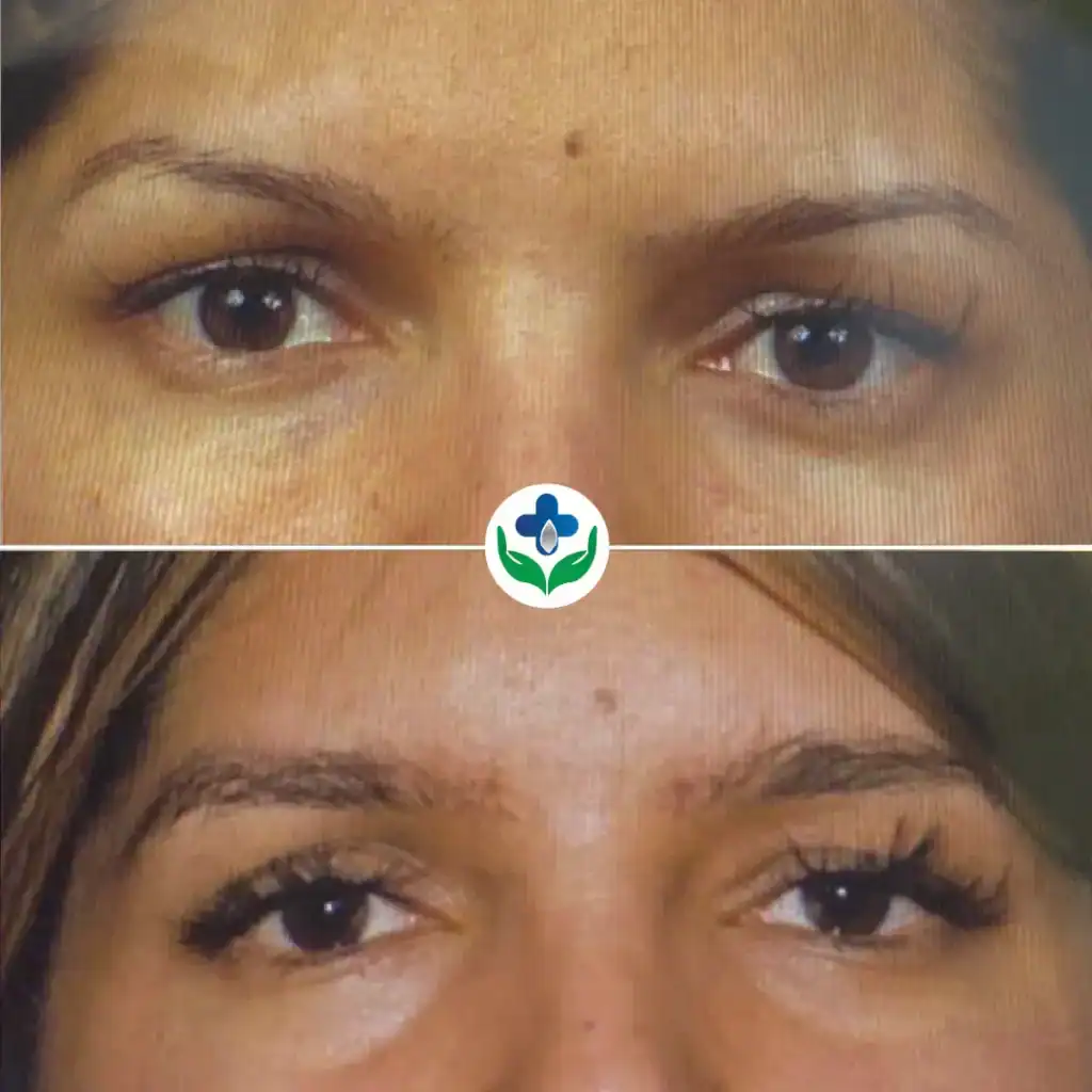Close-up of skin improvement after treatment.