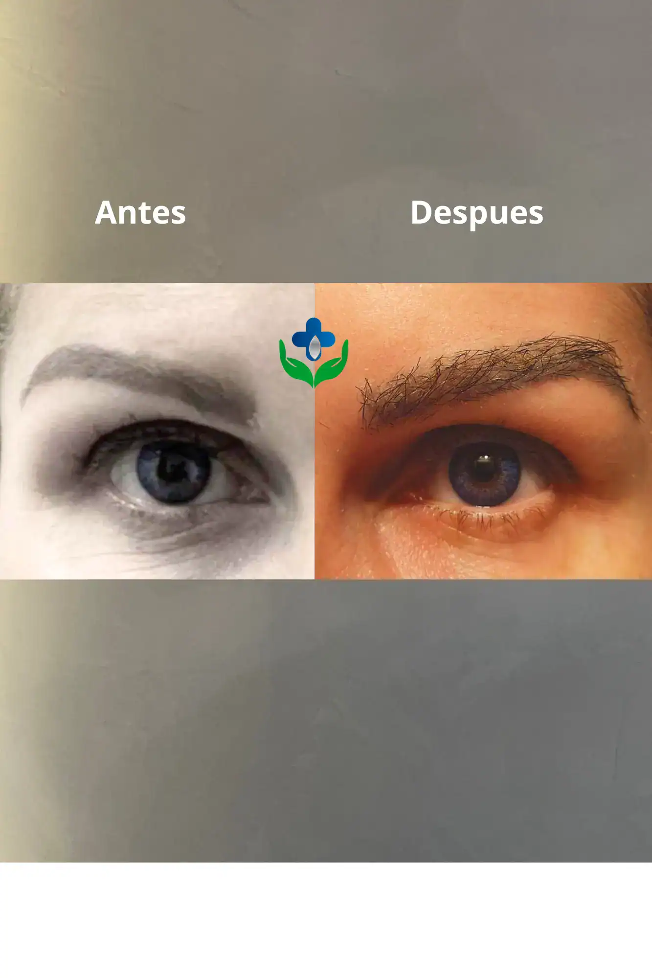Trasplante Cejas Medellin