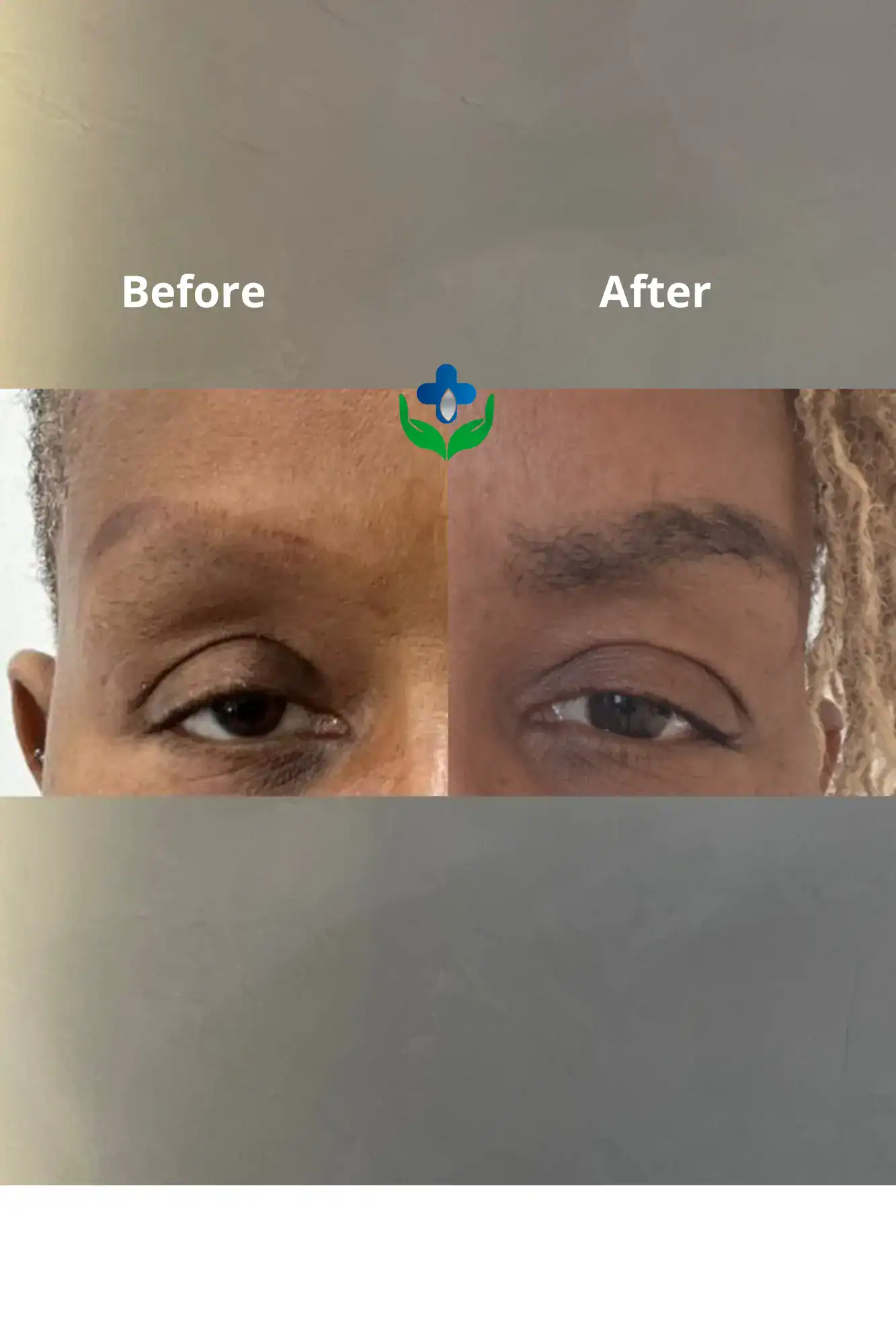 Before and after skin improvement showing significant reduction in blemishes and scars.