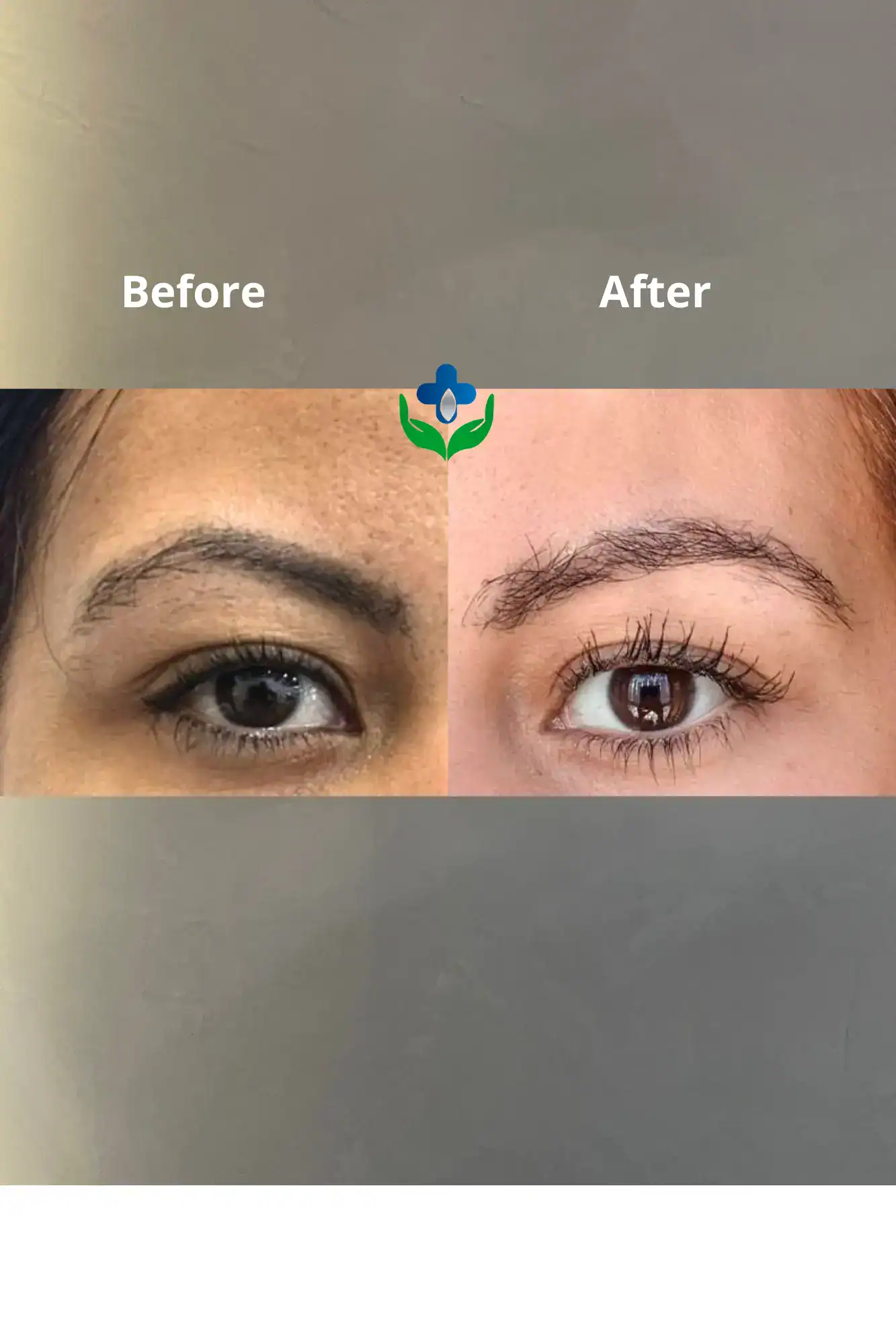 Before and after comparison of eyebrow enhancement showing significant skin and eyebrow improvement.
