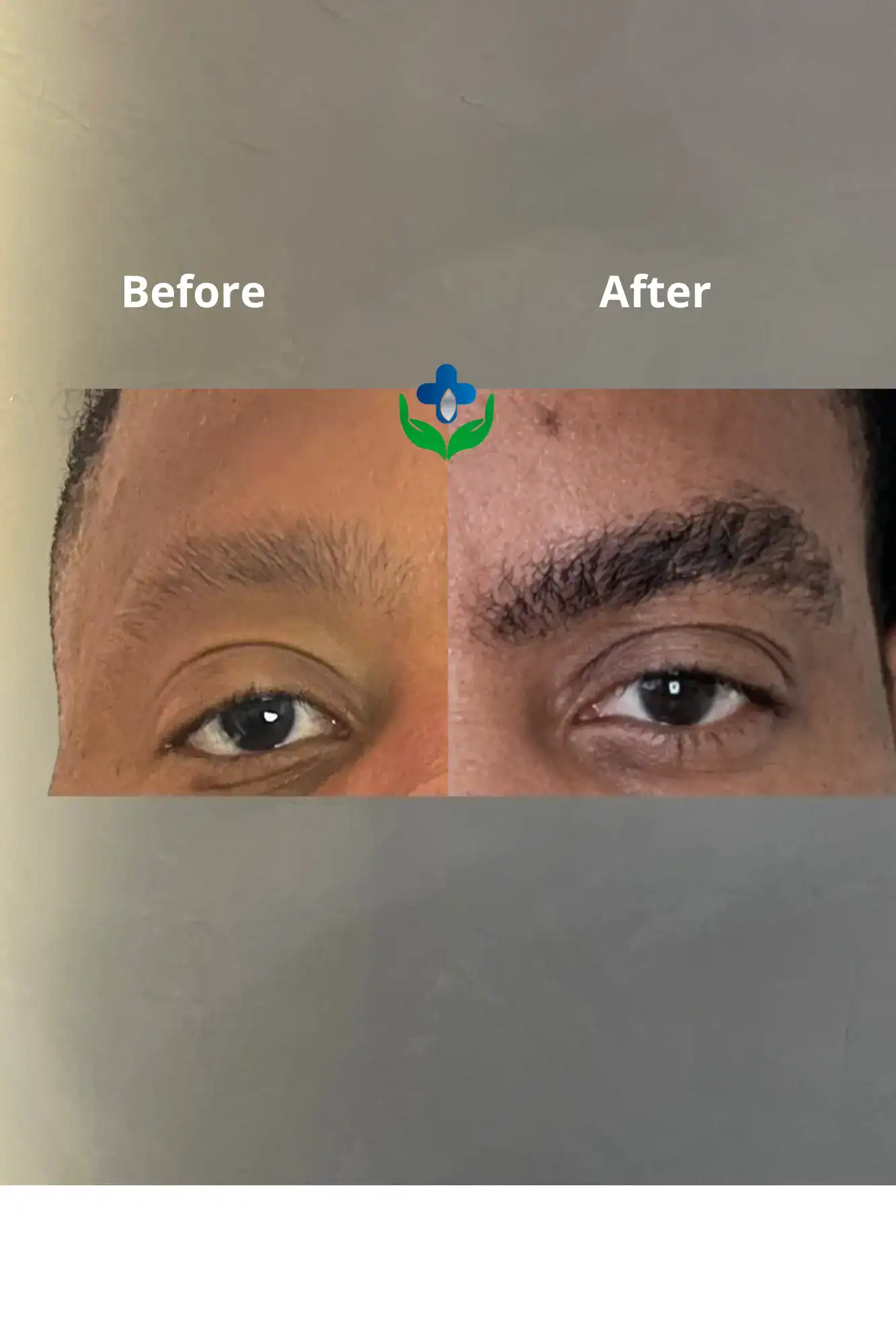 Before and after eyebrow improvement treatment.