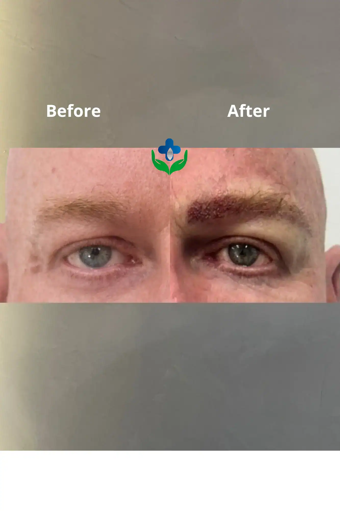 Before and after skin treatment showing improved complexion and reduced blemishes.