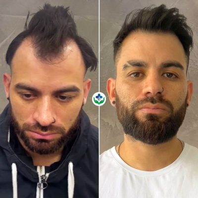 WhatsApp Image 2023-06-15 at 11.38.37 hair transplant colombia care