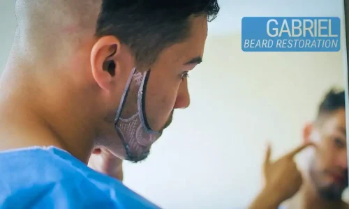Man receiving hair transplant in Colombia clinic, close-up view.